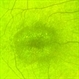 Cone Dystrophy